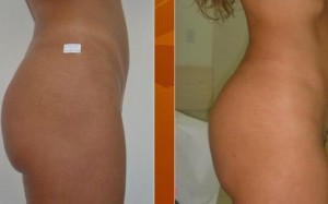 MASOTERAPIA CORPORAL Anuncios gratis para novios en Las Condes |  PIERDE CENTIMETROS PARA TU NOCHE DE BODAS PREPARATE CON ANTICIPACI&Oacute;N !!,  A DOMICILIO TRATAMIENTOS REDUCTIVOS EN EL CUERPO COMPLETO